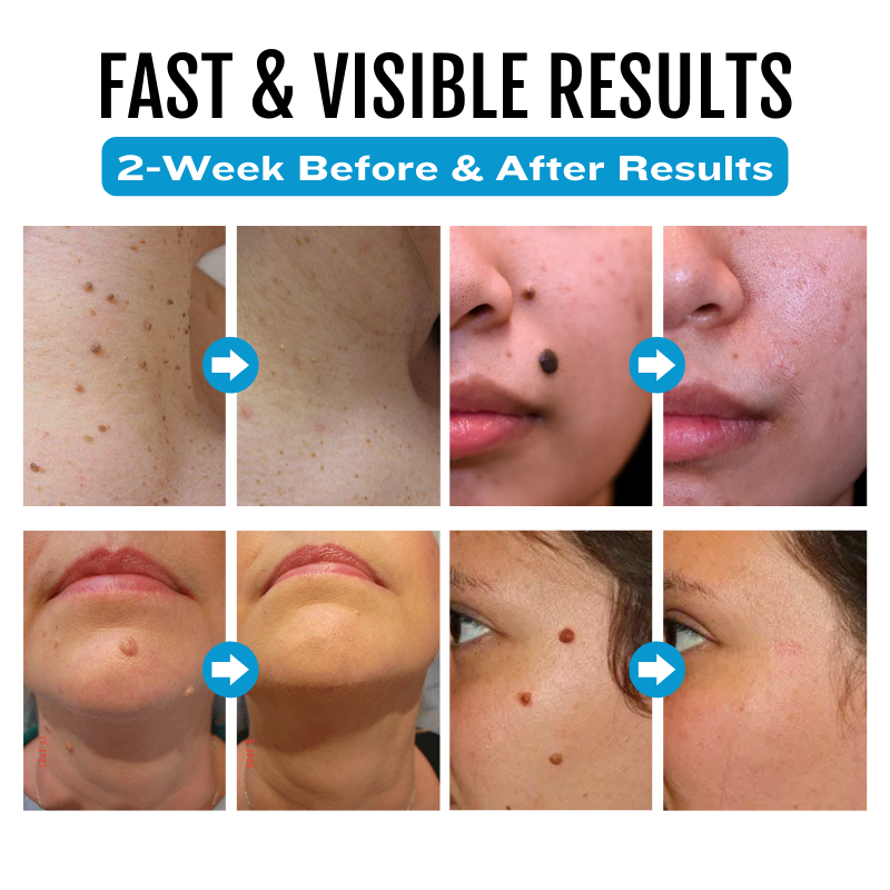 SpotlessDerm Mole and Wart Laser Pen