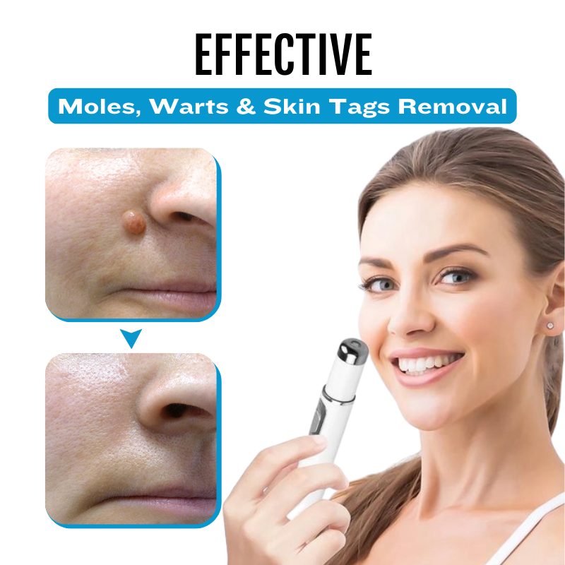 SpotlessDerm Mole and Wart Laser Pen