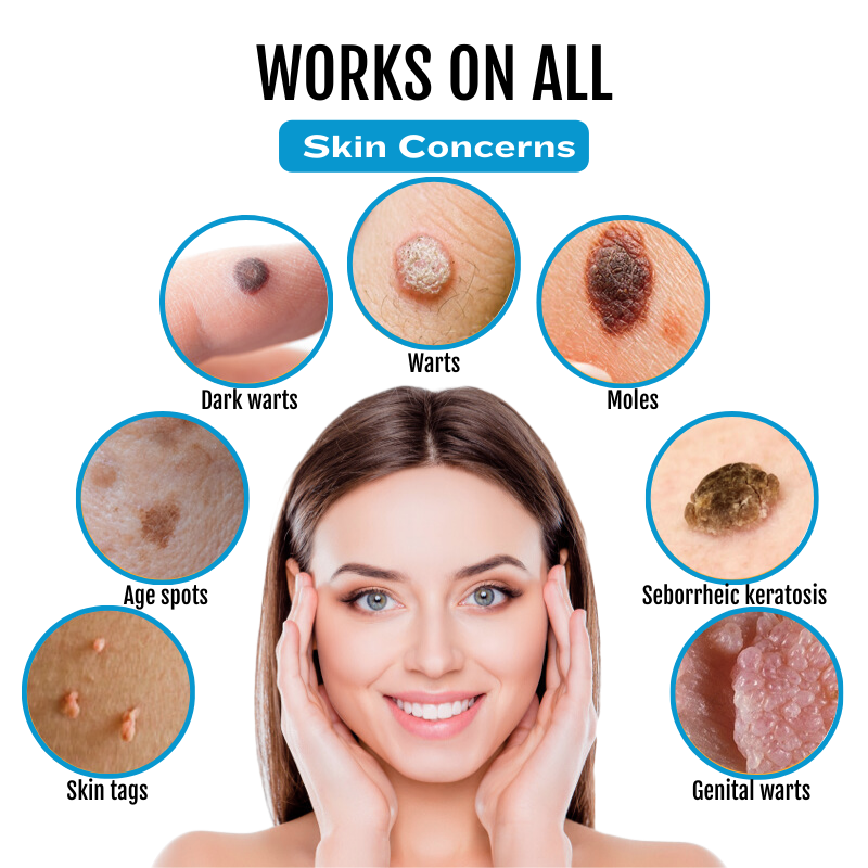 SpotlessDerm Mole and Wart Laser Pen